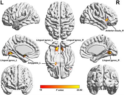 Abnormal brain spontaneous neural activity in neuromyelitis optica spectrum disorder with neuropathic pain